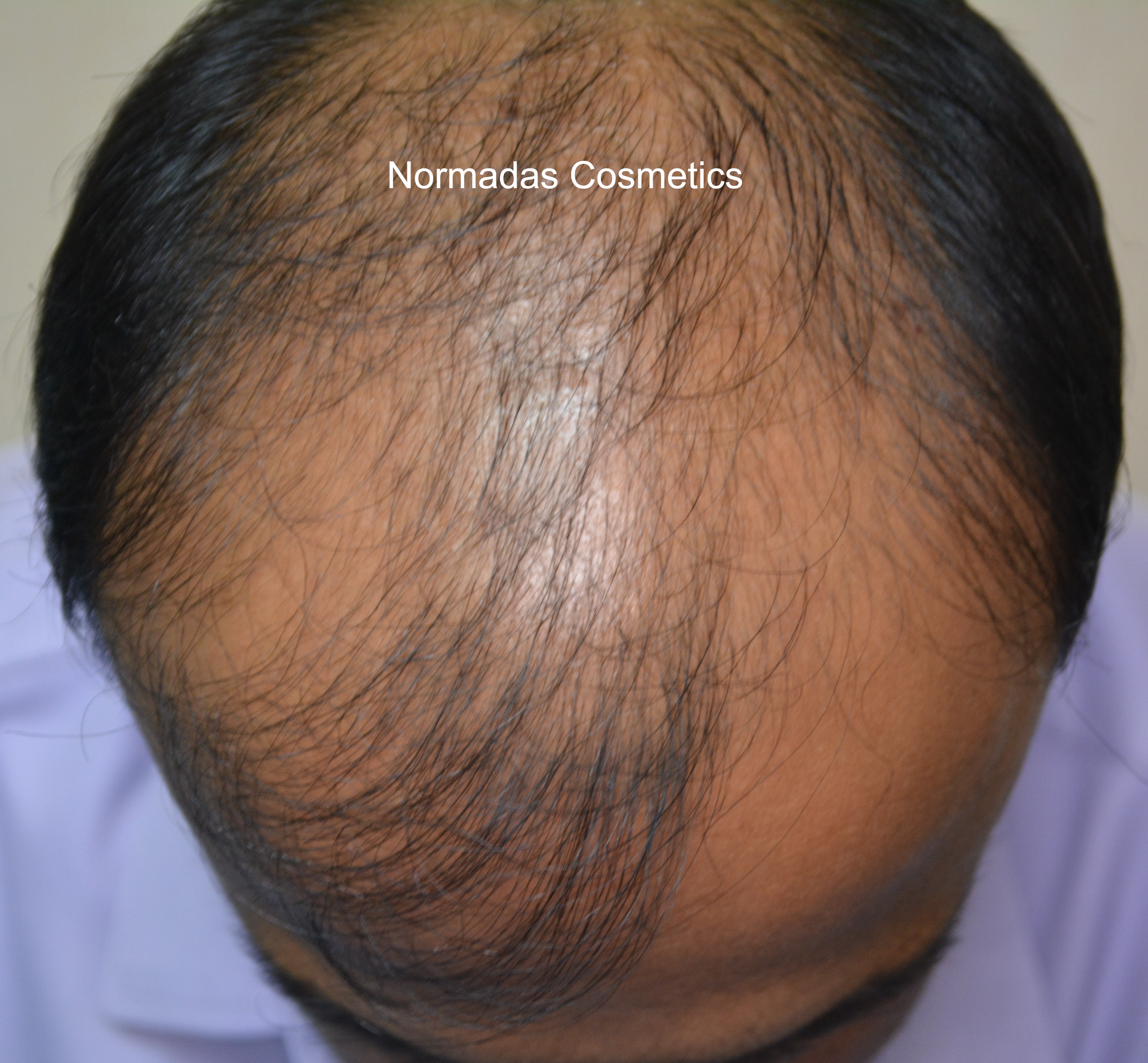 Thinning hair before
