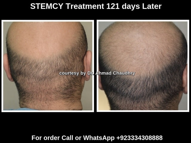 Baldness grade 7 hair growth treatment
