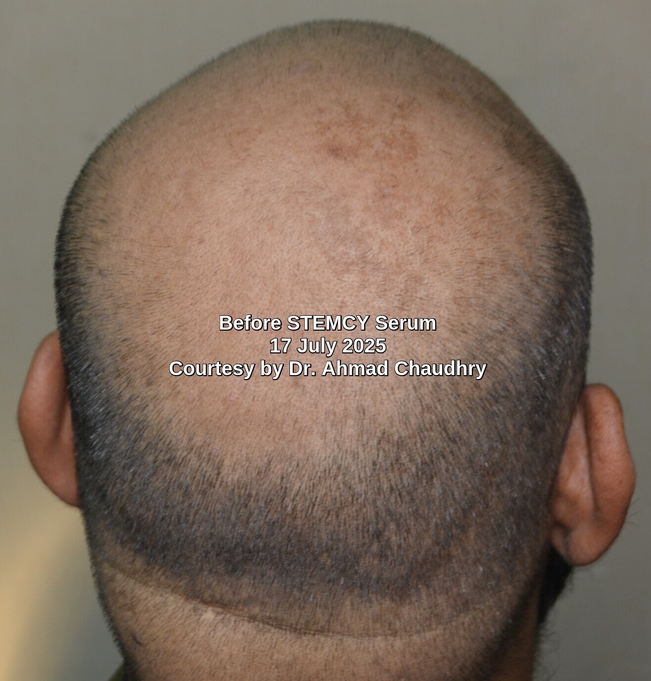 Crown area baldness treatment